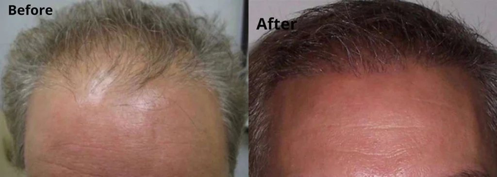 Hair Transplant before and after photos by Dr. Demetri Arnaoutakis in Tampa, FL