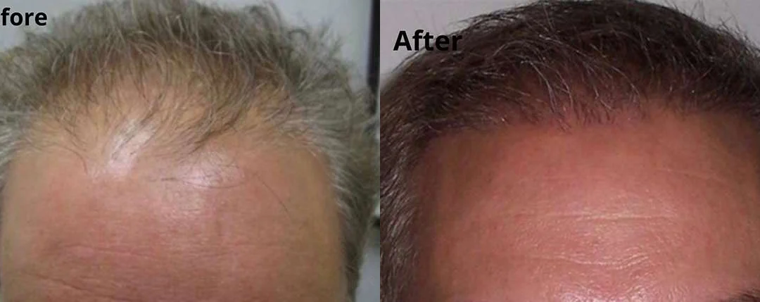 Hair Transplant before and after photos by Dr. Demetri Arnaoutakis in Tampa, FL