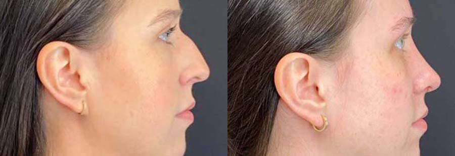 Rhinoplasty before and after photos by Dr. Demetri Arnaoutakis in Tampa, FL