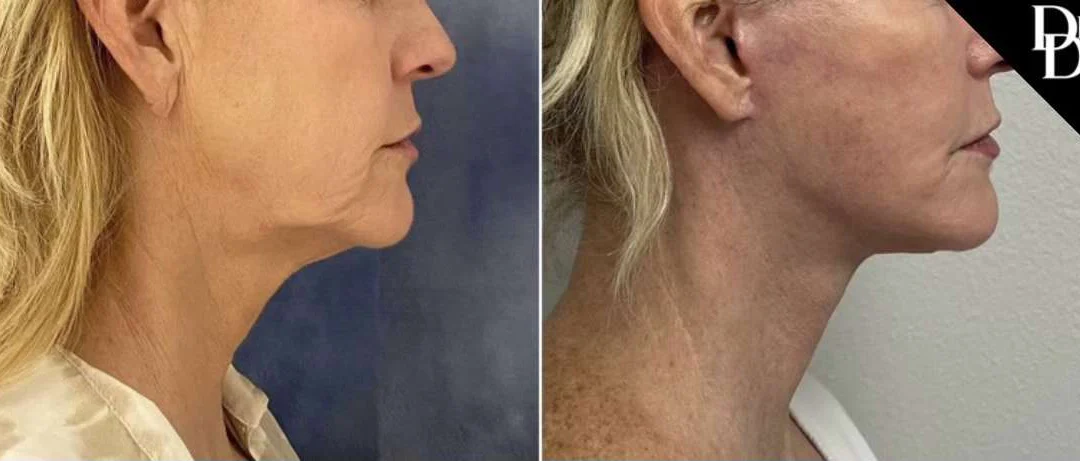 Facelift before and after photos by Dr. Demetri Arnaoutakis in Tampa, FL