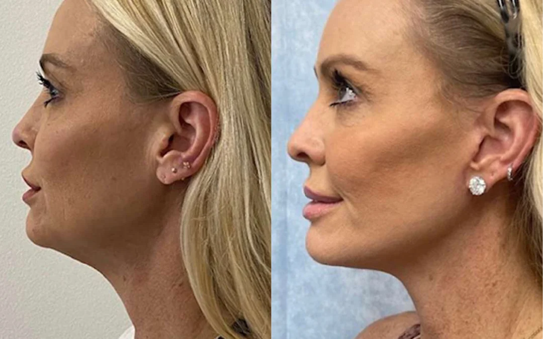 Facelift before and after photos by Dr. Demetri Arnaoutakis in Tampa, FL