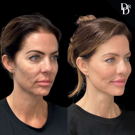 facelift before and after