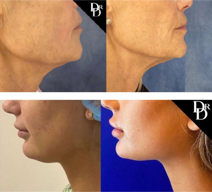 morpheus before and after patient images performed by dr demetri