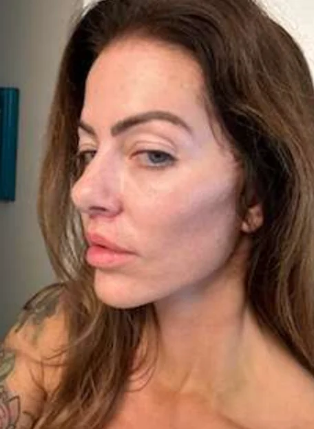 woman with almost fully recovered face after facelift surgery