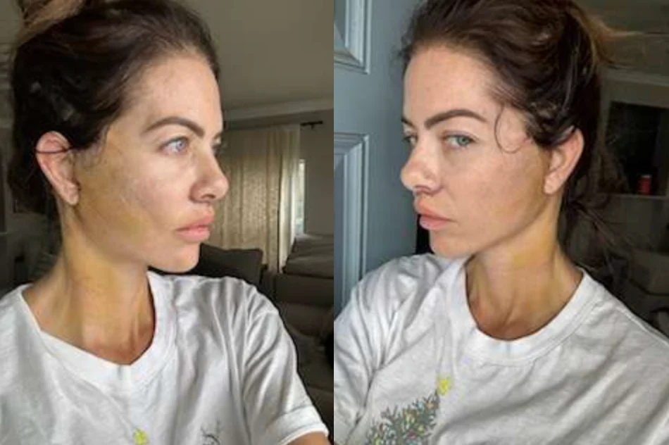 woman with visible bruises on face on day after facelift surgery