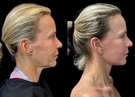 Facelift before and after photos by Dr. Demetri Arnaoutakis in Tampa, FL