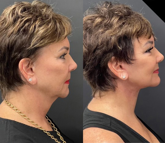 facelift before and after photos by dr demetri arnaoutakis in tampa fl