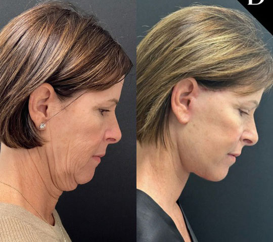 facelift before and after photos by dr demetri arnaoutakis in tampa fl