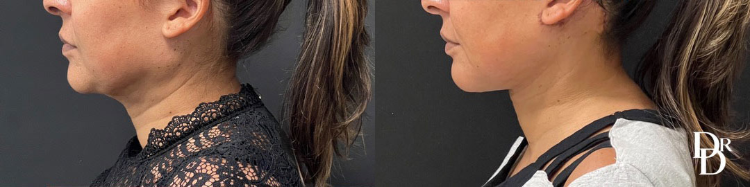 Neck Lift before and after photos by Dr. Demetri Arnaoutakis in Tampa, FL